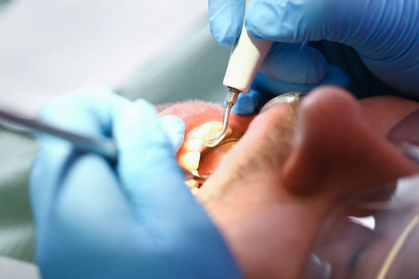 Best Emergency Root Canal Treatment in Effort, PA