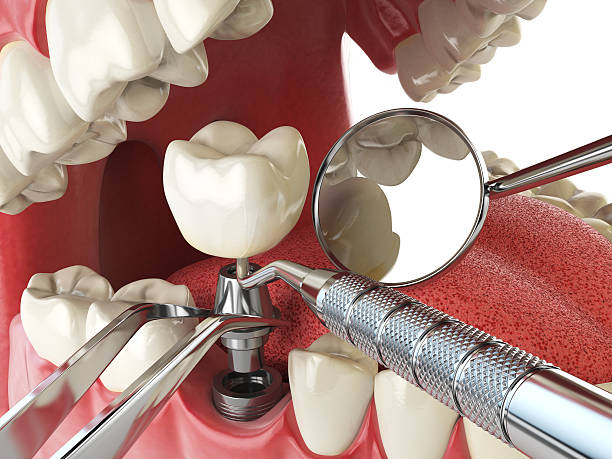 Best Urgent Care for Lost Fillings or Crowns in Effort, PA
